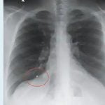 12 വര്‍ഷം മുമ്പ് കാണാതായ മൂക്കുത്തിയുടെ ഭാഗം ശ്വാസകോശത്തില്‍