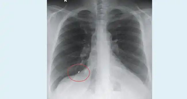 12 വര്ഷം മുമ്പ് കാണാതായ മൂക്കുത്തിയുടെ ഭാഗം ശ്വാസകോശത്തില്