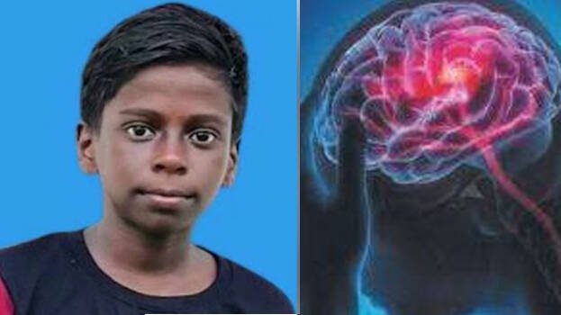 അമീബിക് മസ്തിഷ്‌കജ്വരം: കോഴിക്കോട്ട് ചികിത്സയിലായിരുന്ന ഏഴാംക്ലാസ് വിദ്യാര്‍ഥി മരിച്ചു