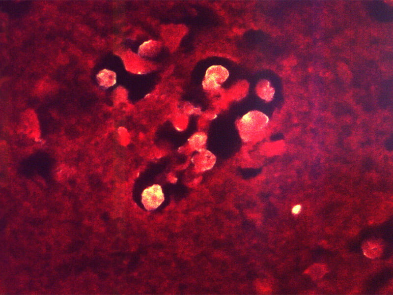 കണ്ണൂര്‍ സ്വദേശിയായ മൂന്നര വയസ്സുകാരന് അമീബിക് മസ്തിഷ്‌കജ്വരം സ്ഥിരീകരിച്ചു