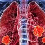 വൈദ്യശാസ്ത്ര ചരിത്രത്തില്‍ ആദ്യമായി ശ്വാസകോശ അര്‍ബുദത്തിനുള്ള വാക്സിന്‍ വികസിപ്പിച്ചു