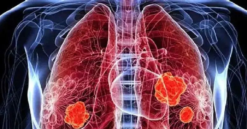 വൈദ്യശാസ്ത്ര ചരിത്രത്തില്‍ ആദ്യമായി ശ്വാസകോശ അര്‍ബുദത്തിനുള്ള വാക്സിന്‍ വികസിപ്പിച്ചു