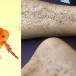 തിരുവനന്തപുരത്ത് മുരിന് ടൈഫസ് രോഗബാധ സ്ഥിരീകരിച്ചു; രാജ്യത്ത് അപൂർവമായി കാണപ്പെടുന്ന രോഗം