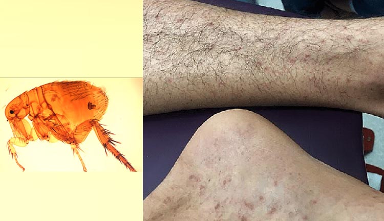 തിരുവനന്തപുരത്ത് മുരിന് ടൈഫസ് രോഗബാധ സ്ഥിരീകരിച്ചു; രാജ്യത്ത് അപൂർവമായി കാണപ്പെടുന്ന രോഗം