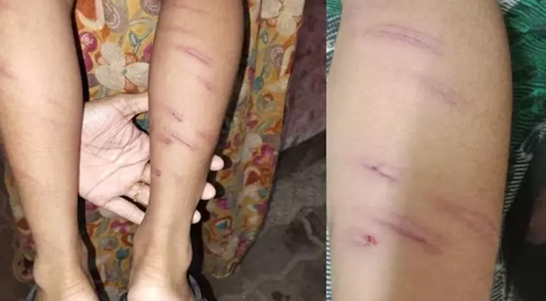 ഡയറി എഴുതാത്തതിന് അഞ്ച് വയസുകാരന് ക്രൂരമര്‍ദ്ദനം; അധ്യാപിക അറസ്റ്റില്‍