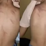 ചോദ്യം ചോദിച്ചതിന് മറുപടി നൽകിയില്ല; എല്കെജി വിദ്യാർഥിക്ക് ക്രൂരമർദനം, അധ്യാപിക അറസ്റ്റില്