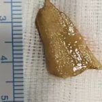 ബീഫ് കറി കഴിച്ചതിന് പിന്നാലെ 84 കാരിക്ക് ദേഹാസ്വാസ്ഥ്യം; പരിശോധനയില് ശ്വാസകോശത്തില് ഇറച്ചിയിലെ എല്ല്