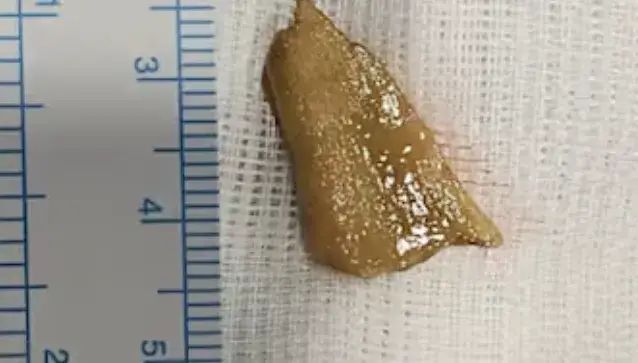 ബീഫ് കറി കഴിച്ചതിന് പിന്നാലെ 84 കാരിക്ക് ദേഹാസ്വാസ്ഥ്യം; പരിശോധനയില്‍ ശ്വാസകോശത്തില്‍ ഇറച്ചിയിലെ എല്ല്