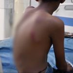 തെരുവുനായയുടെ ആക്രമണത്തിൽ പന്ത്രണ്ടുകാരന് ഗുരുതര പരുക്ക്