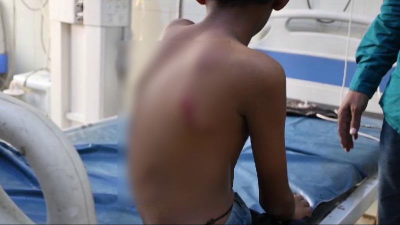 തെരുവുനായയുടെ ആക്രമണത്തിൽ പന്ത്രണ്ടുകാരന് ഗുരുതര പരുക്ക്