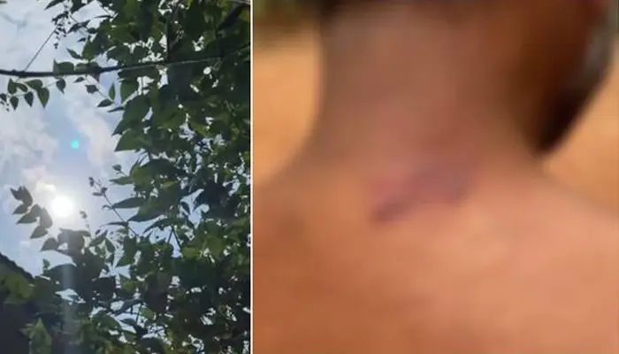 കോഴിക്കോട് കര്ഷകന് സൂര്യാഘാതമേറ്റു